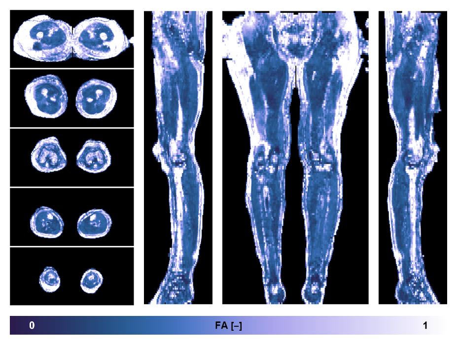 IVIM corrected whole leg muscle fractional anisotropy obtained from diffusion tensor imaging.